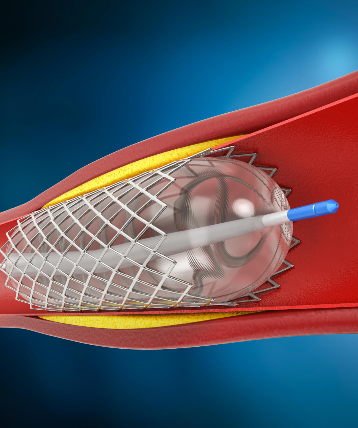 stent