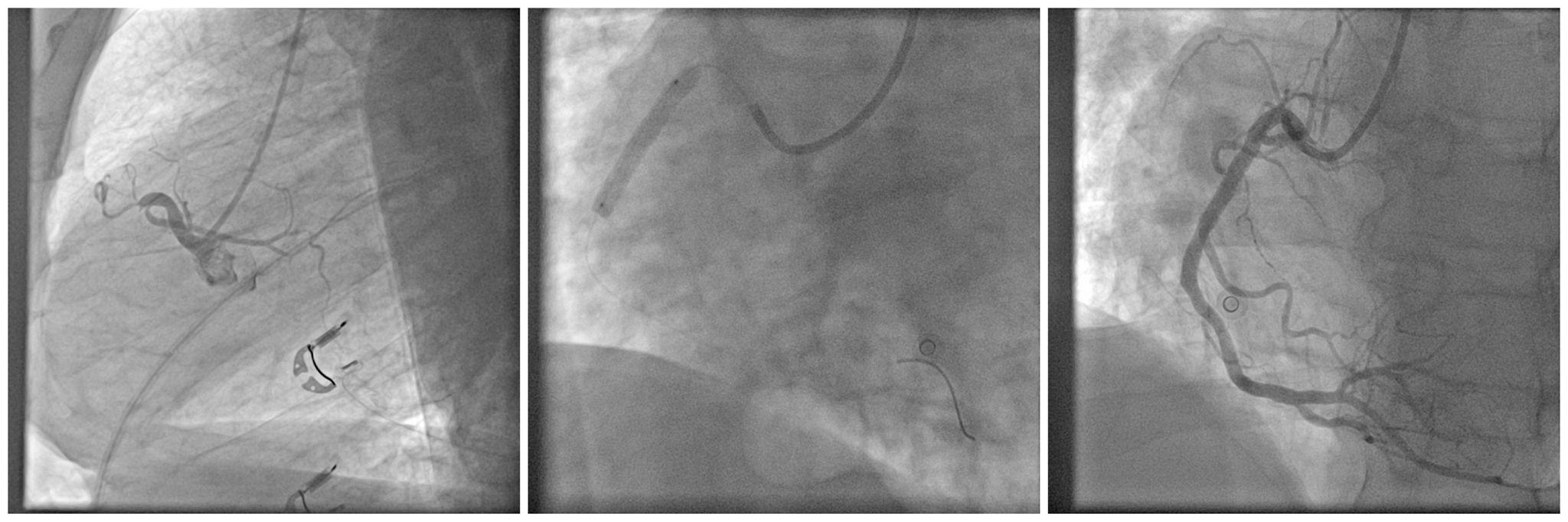 PCI