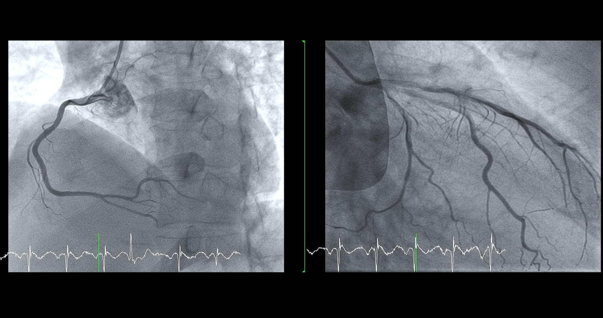 diagnostic cardiac catheterization